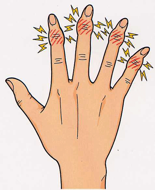 手の親指の第一関節の痛み！ヘバーデン結節が原因？